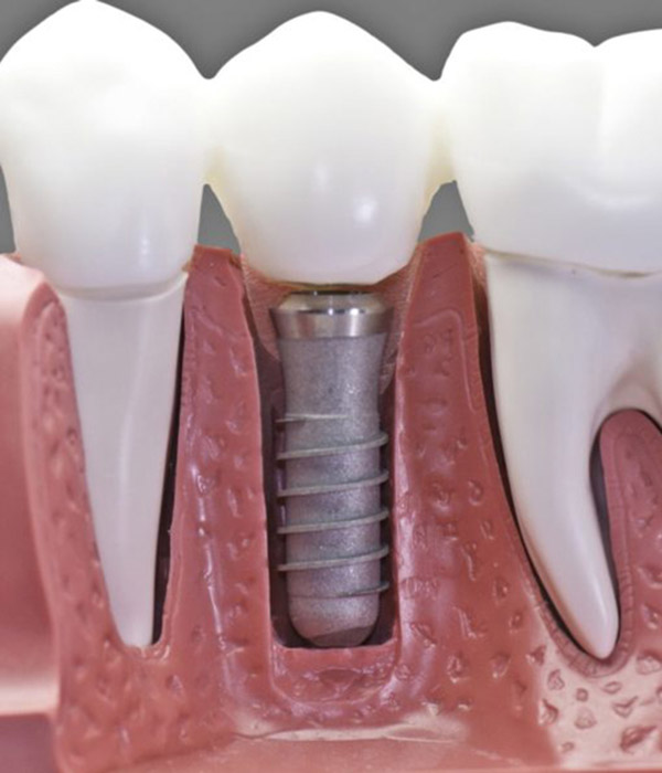 implante dental Granada