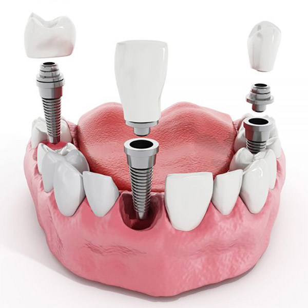 implantes dentales Granada
