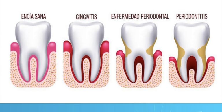 Gengivitis y periodontitis