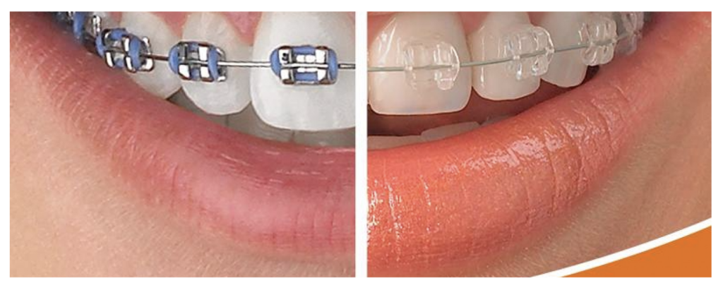 boca con ortodoncia estética vs convencional