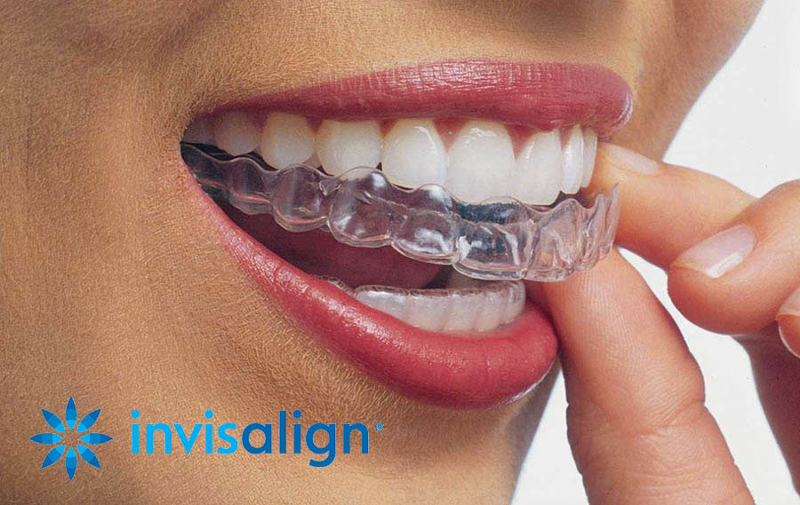 ortodoncia invisible invisalign