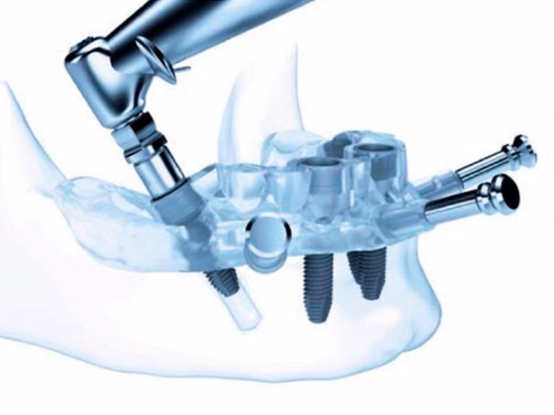 Cirugía implantológica guiada