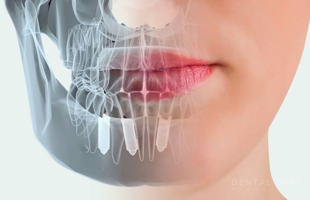 implantes dentales en granada