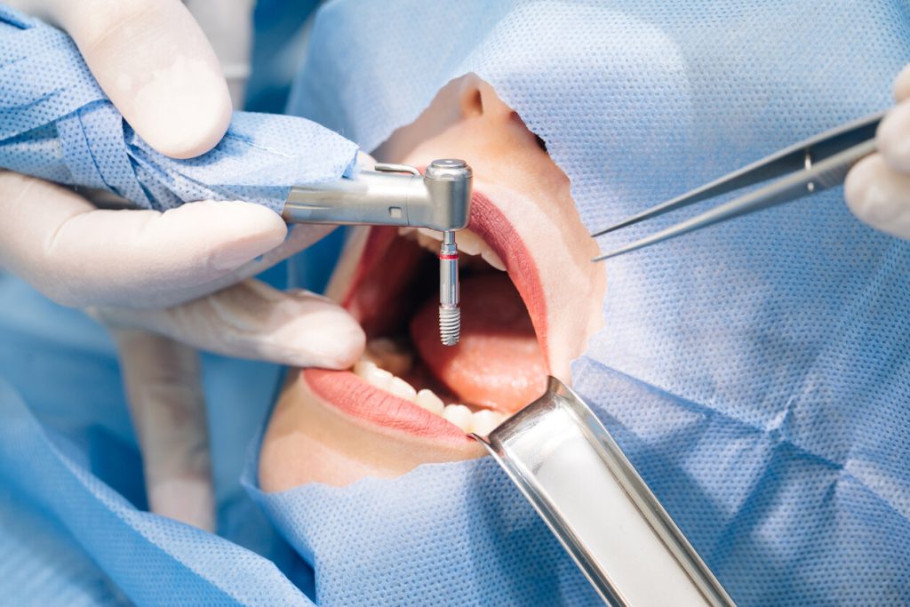 Procedimientos técnicos necesarios para realizar un implante dental con éxito